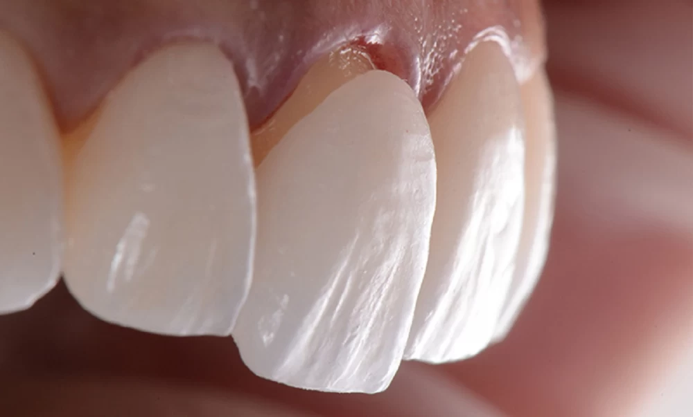 چسباندن روکش دندان