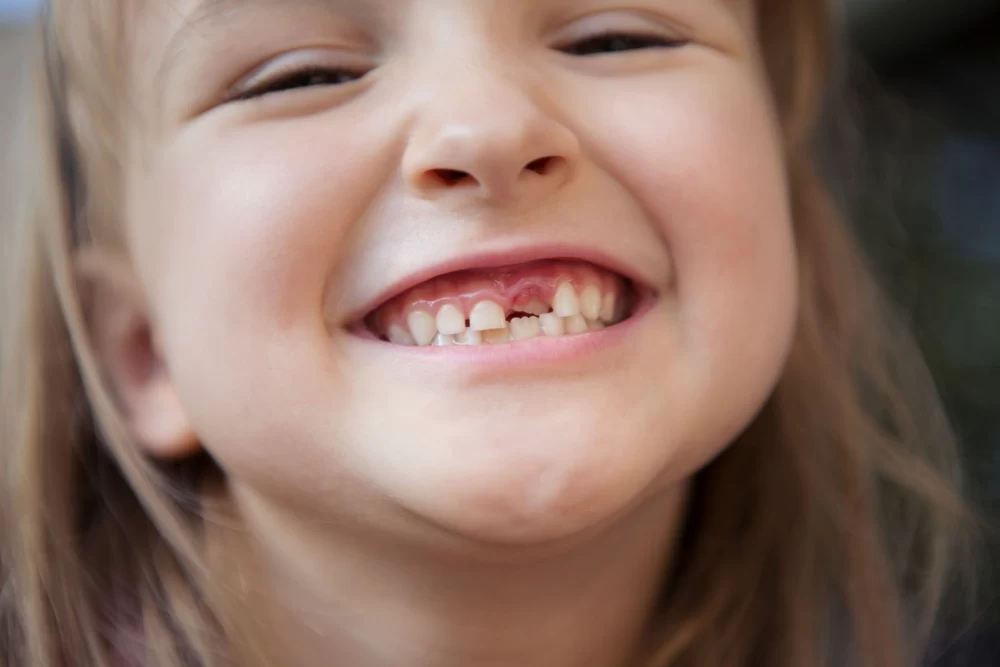  در نیامدن دندان بعد از افتادن دندان شیری