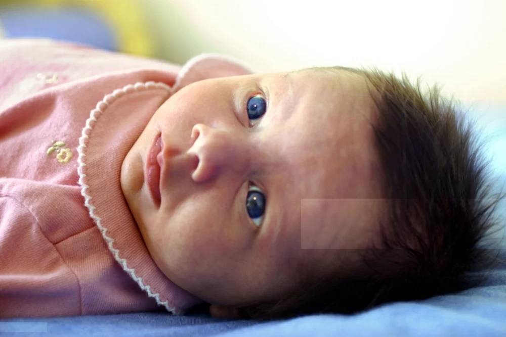 درمان زردی چشمان نوزاد