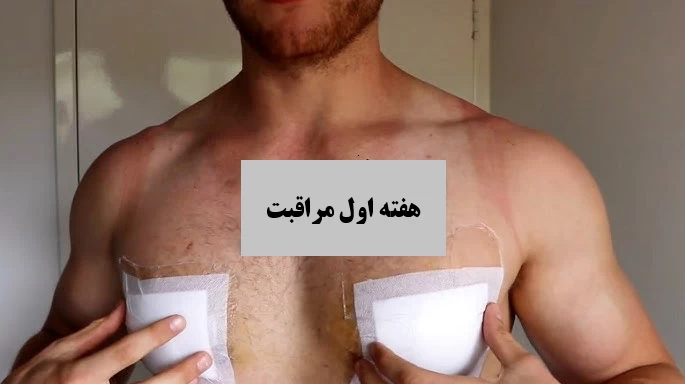 مدت زمان بهبود و مراقبت‌های پس از جراحی ژنیکوماستی
