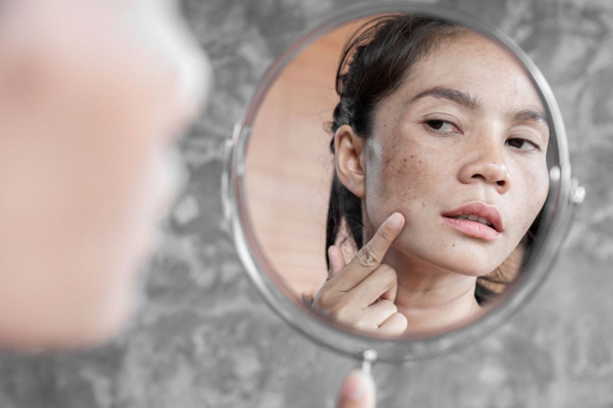 بهترین روغن برای لک قهوه ای صورت
