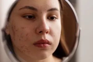 مواد غذایی عامل جوش صورت؛ کدام خوراکی ها پوست را مستعد آکنه می کنند؟