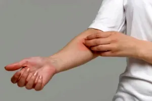 چرا بدن در شب می خارد؟ ۷ دلیل خارش شبانه + روش التیام