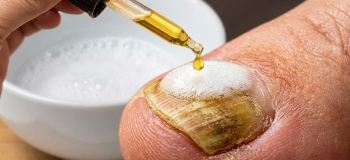 روش طبیعی از بین بردن قارچ ناخن در ۲۰ دقیقه