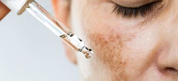 درمان لک قهوه ای صورت با روغن های گیاهی : معرفی ۷ روغن مؤثر + روش استفاده