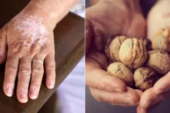 با فواید پوست گردو برای پیسی آشنا شوید