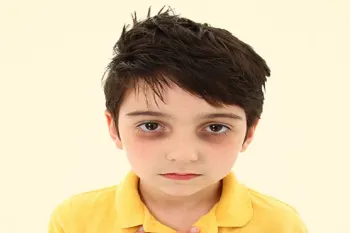 علت و درمان سیاهی زیر چشم کودکان