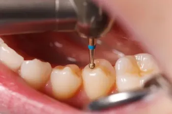 آیا پر کردن دندان تاثیری بر روی سلامت قلب دارد؟