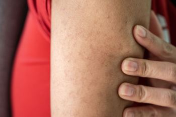 چرا لکه های قهوه ای روی پوست ایجاد می شوند؟