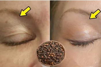 از بین بردن پوست پشت پلک بدون نیاز به جراحی / روش طبیعی برای لیفت چشم