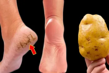 روش طبیعی برای از بین بردن ترک کف پا با سیب زمینی / تا سالها کف پا ترک نمیخوره