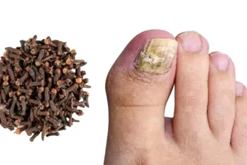از بین بردن قارچ ناخن پا با میخک / درمان خانگی قارچ ناخن در عرض چند ثانیه