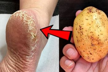 از بین بردن خشکی و ترک پاشنه پا با ۱ عدد سیب زمینی