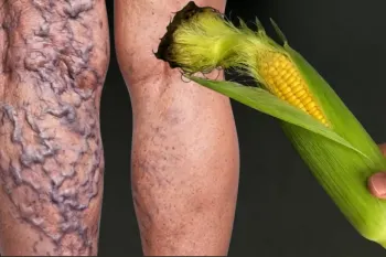 با این گیاه معجزه گر، التهابات مفصلی، واریس و مشکلات کلیوی را درمان کنید