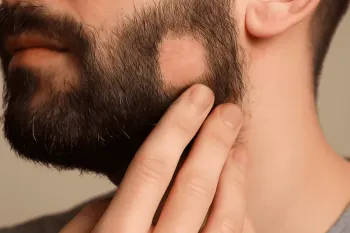 ریزش سکه ای ریش چیست و چگونه آن را درمان کنیم؟