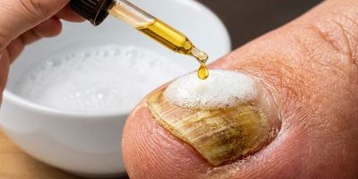 روش طبیعی از بین